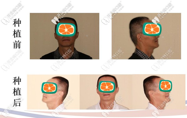 牙周炎做種植牙后效果圖 牙周炎做種植牙后效果圖