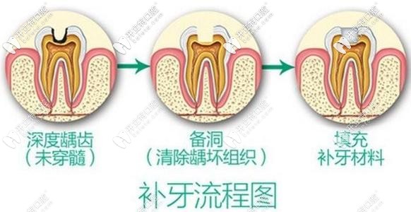 蛀牙別拖久喲!偷偷告訴你杭州做3M樹脂補(bǔ)牙的價(jià)格在這！