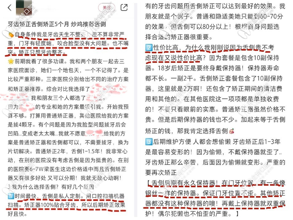 舌側隱形矯正親身經歷者評價