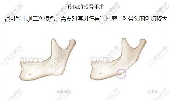 做之前要對目前主流的正頜手術方法進行了解