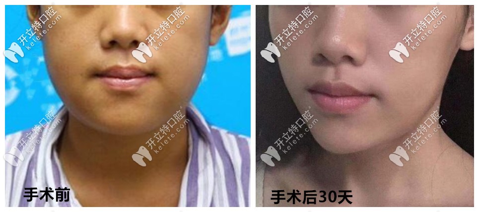 骨性地包天手術前后效果對比圖