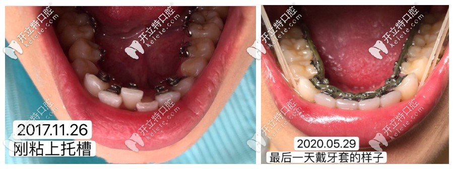 關(guān)注舌側(cè)隱形矯正價(jià)格的同時(shí),eBrace舌側(cè)矯正的效果你知道嗎