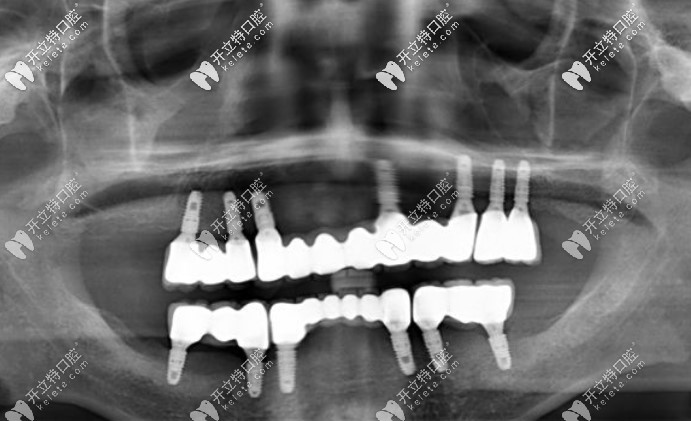 在美奧口腔做全口種植牙效果圖 在美奧口腔做全口種植牙效果圖