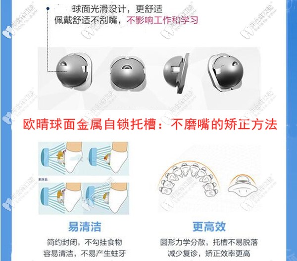 歐晴金屬自鎖托槽牙齒矯正的優(yōu)勢(shì)