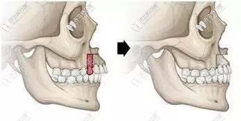 牙齒下頜骨圖示