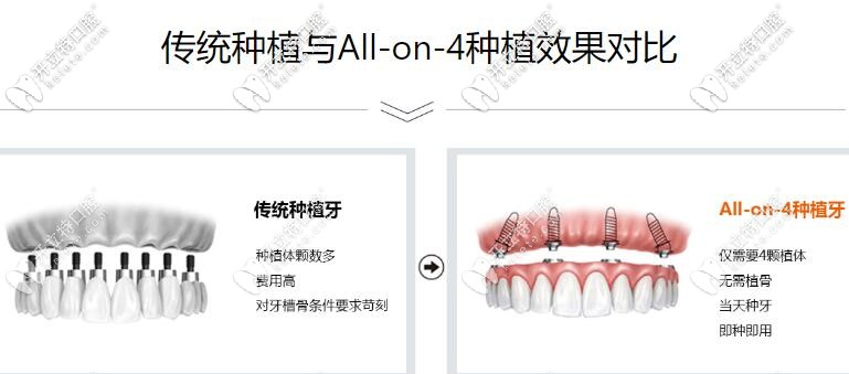 ALL-on-4即刻負(fù)重種植牙優(yōu)勢(shì) ALL-on-4即刻負(fù)重種植牙優(yōu)勢(shì)