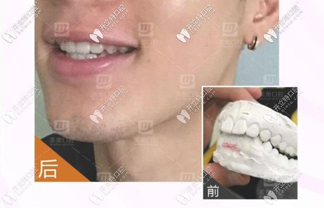 30歲前牙深覆合矯正前后對比圖