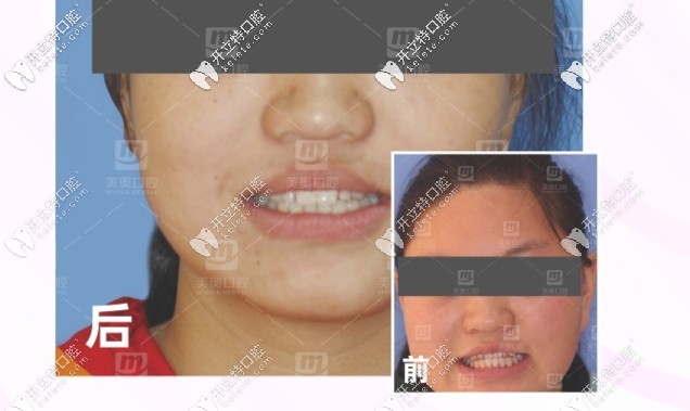 地包天矯正前后對比圖