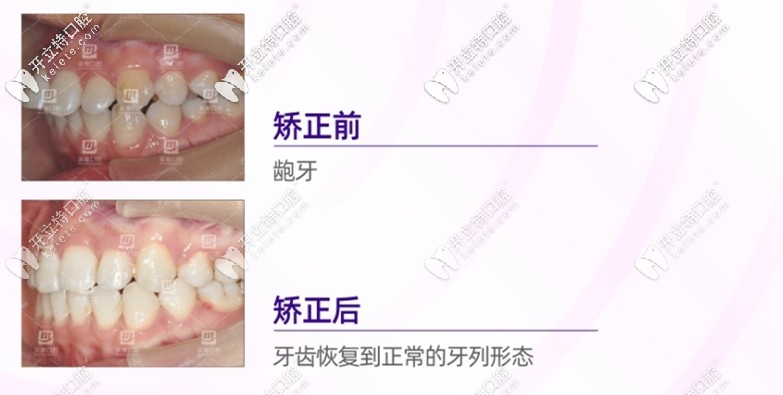 齙牙矯正口內(nèi)效果