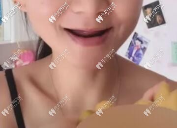 20歲全口無(wú)牙活像80歲老太