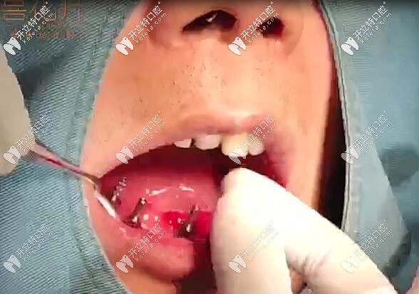 <!--<i data=20240703-sp></i>-->口腔半口即刻負(fù)重種植牙<span style= <!--<i data=20240703-sp></i>-->口腔半口即刻負(fù)重種植牙<span style=