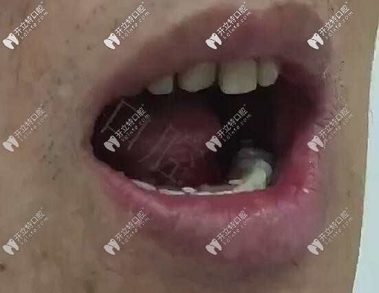 <!--<i data=20240703-sp></i>-->口腔半口all-on-6登騰即刻負(fù)重種植牙<span style= <!--<i data=20240703-sp></i>-->口腔半口all-on-6登騰即刻負(fù)重種植牙<span style=