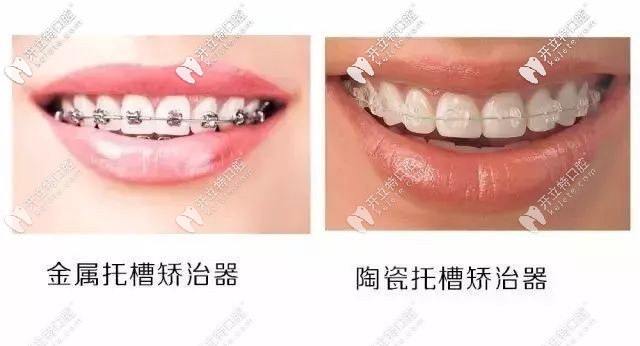 金屬矯正和陶瓷托槽矯正 金屬矯正和陶瓷托槽矯正
