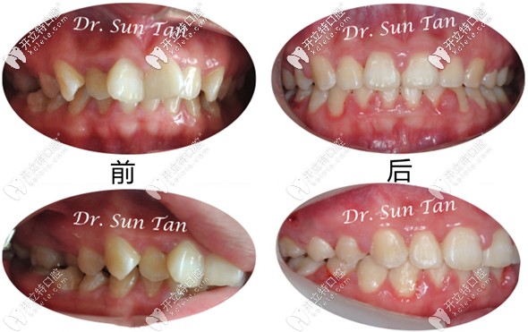據(jù)說insignia正畸價格和隱適美差不多？