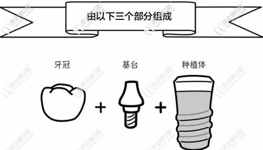 種植牙由以下三個(gè)部分組成
