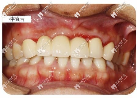 種植牙后