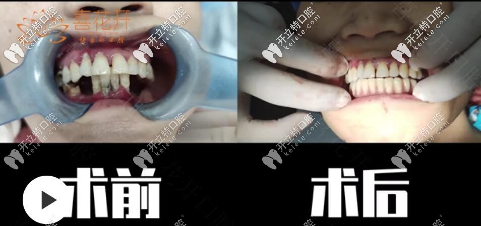 <!--<i data=20240703-sp></i>-->口腔即刻負重種植牙<span style= <!--<i data=20240703-sp></i>-->口腔即刻負重種植牙<span style=