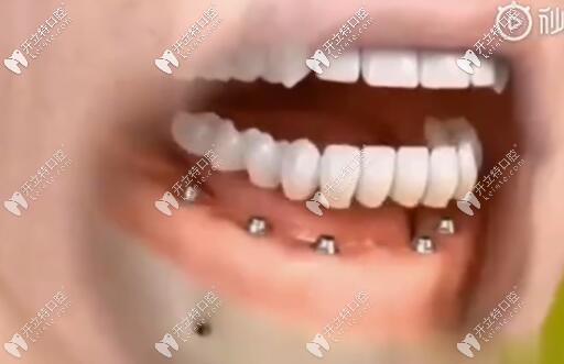 即刻負重種植牙 即刻負重種植牙