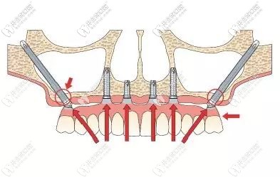 快看穿顴骨種植牙的經(jīng)歷和費(fèi)用,以防牙齦植入骨粉很后悔