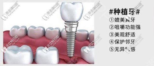 什么是種植牙