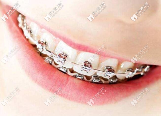 傳統(tǒng)金屬矯正