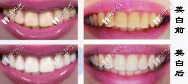 澳大利亞pola牙齒美白效果
