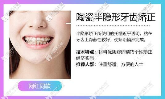 半隱形矯正的優(yōu)勢