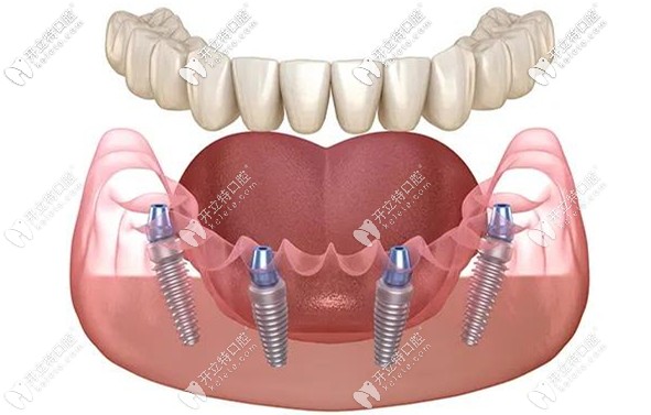 All-on-4種植修復(fù)技術(shù) All-on-4種植修復(fù)技術(shù)