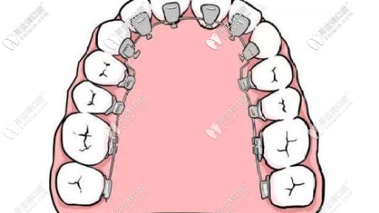 舌側(cè)矯正對醫(yī)生要求更多 舌側(cè)矯正對醫(yī)生要求更多