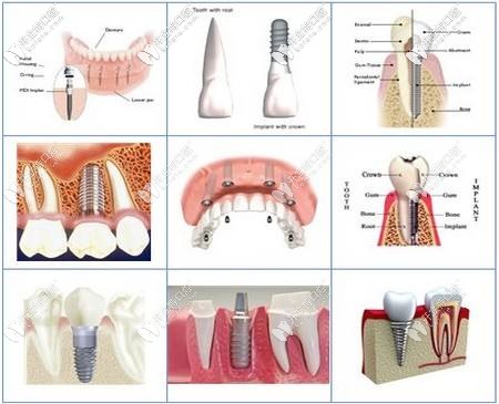 種植牙的過(guò)程