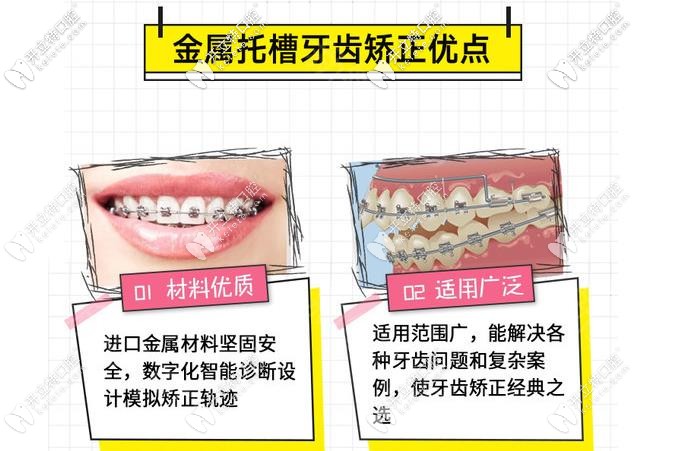 金屬矯正的優(yōu)勢 金屬矯正的優(yōu)勢