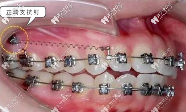 牙齒矯正支抗釘?shù)淖饔? border=