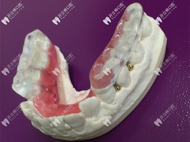 后牙做頜墊打開咬合