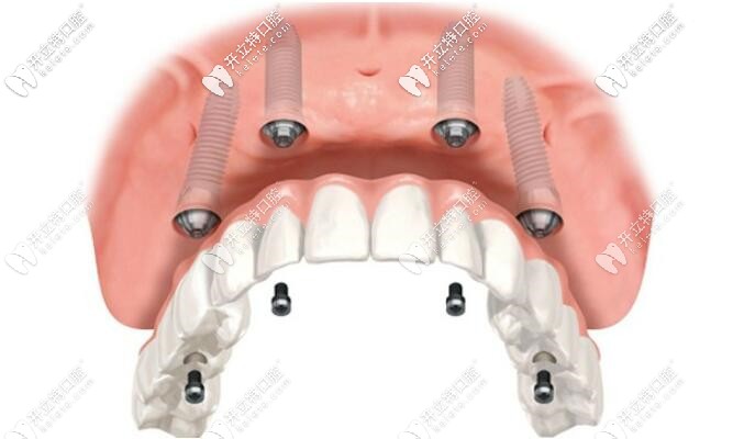 半口種植牙圖片