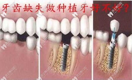 種植牙圖片