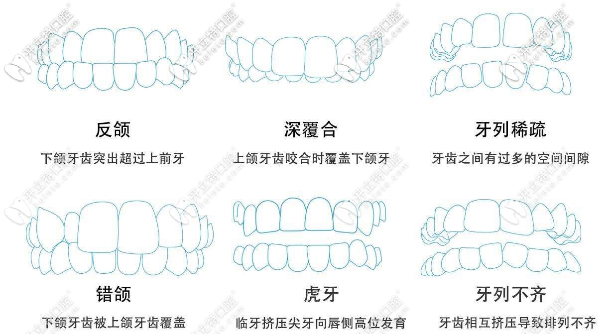 青少年牙齒矯正適應癥