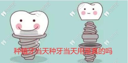 種植牙當(dāng)天種當(dāng)天用靠譜嗎