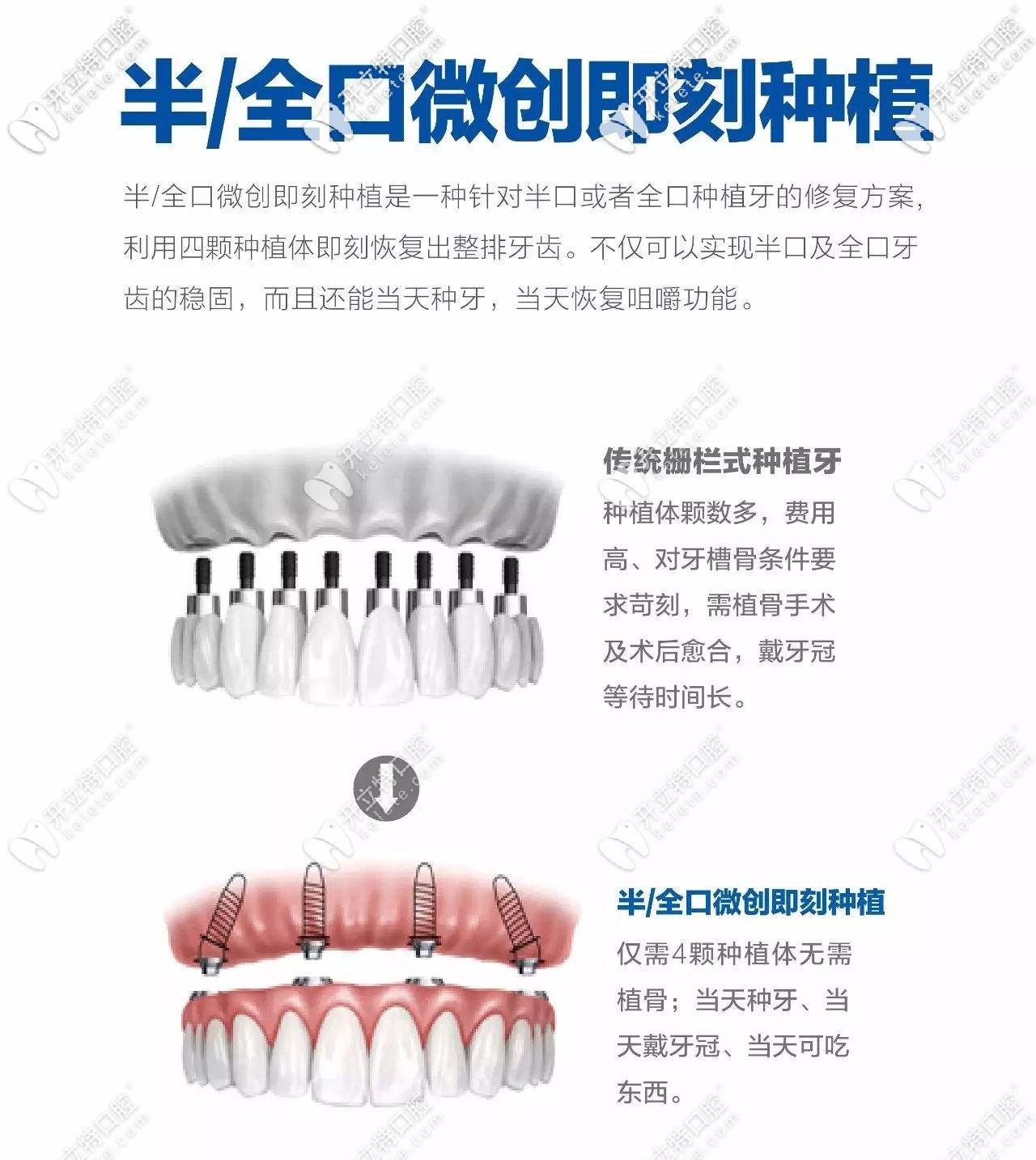即刻種植和傳統(tǒng)種植對(duì)比