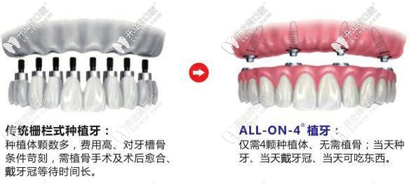 傳統(tǒng)種植牙和all on 4種植牙對(duì)比