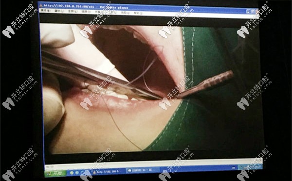 種植牙手術(shù)直播現(xiàn)場(chǎng)