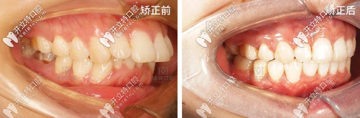 成年后牙齒越來越突