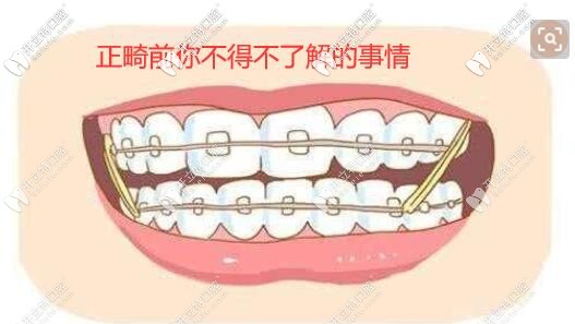 正畸前需要知道的事情