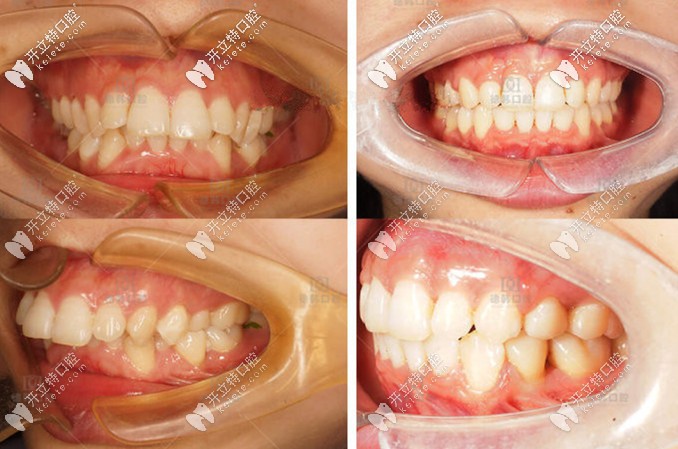 齙牙矯正前后對比圖