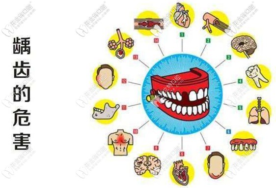 齲齒自然也會(huì)影響兒童的牙齒 齲齒自然也會(huì)影響兒童的牙齒