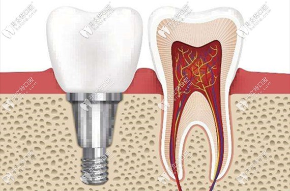 種植牙的費(fèi)用主要包含種植體、牙冠這兩大塊