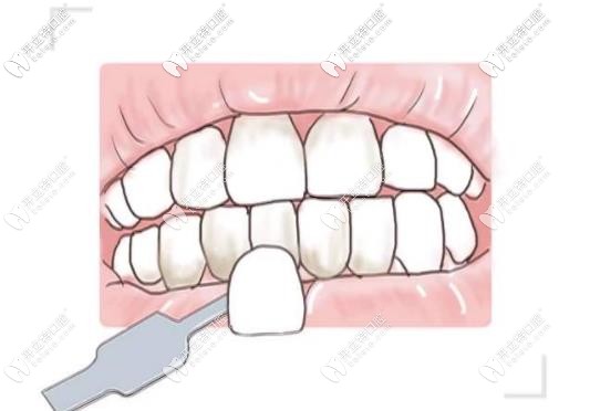 牙齒貼面修復(fù)