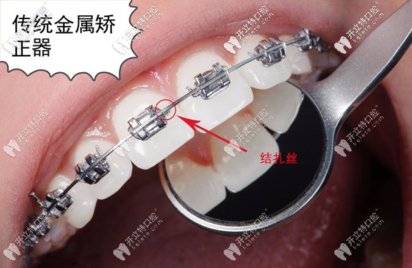 傳統(tǒng)金屬矯正器