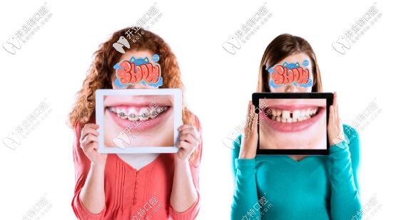 進(jìn)口金屬自鎖牙齒矯正