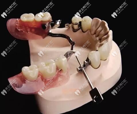 精密附著體義齒