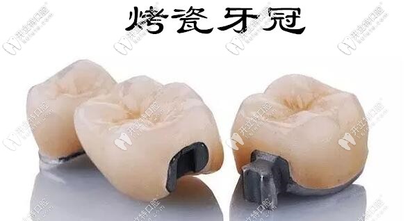 烤瓷牙邊緣發(fā)黑怎么修復